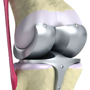 joint replacement surgery