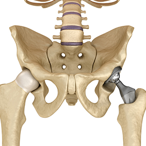 pelviacetabular surgery