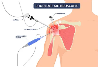 shoulder arthroscopy